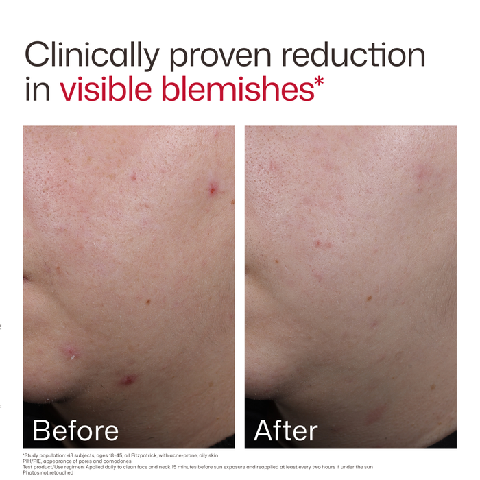 Before and after comparison of visible blemishes on skin with text indicating clinically proven reduction.