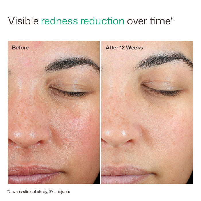 Before and after comparison of visible redness reduction on a person's face over 12 weeks.